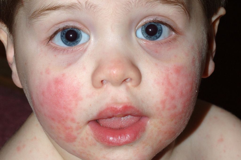 Childs Skin Rash - Slapped Cheek Syndrome