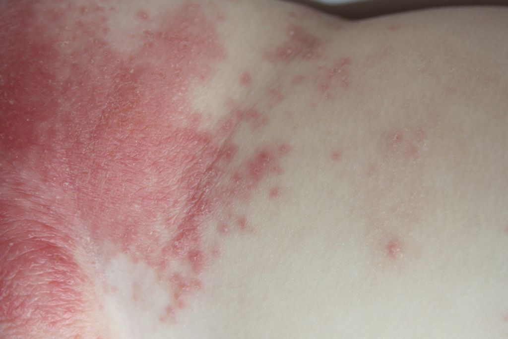 Common Child Skin Problems - Heat Rash