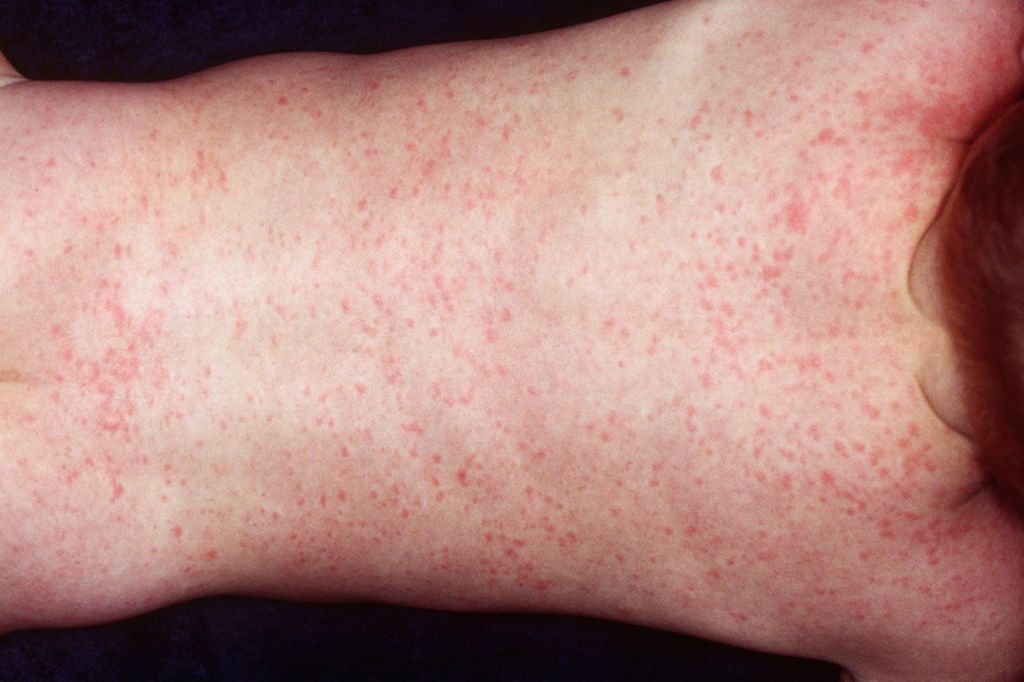Childs Skin Rash - Roseola Infantum