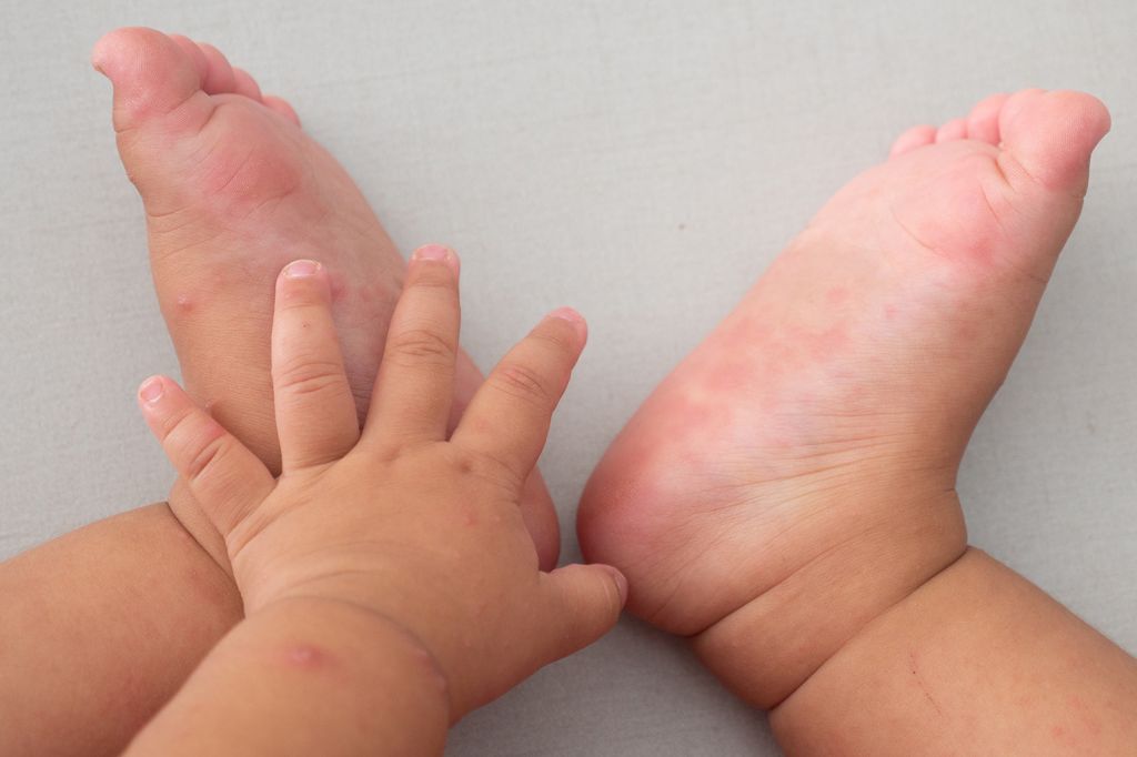 Childs Skin Rash - Hand, foot and mouth disease