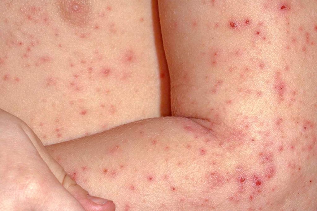 Common Child Skin Problems - Contact Dermatitis