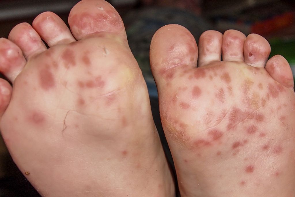 Common Child Skin Problems - Hand-Foot-Mouth Disease