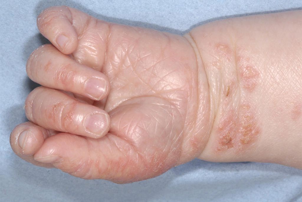Common Child Skin Problems - Eczema