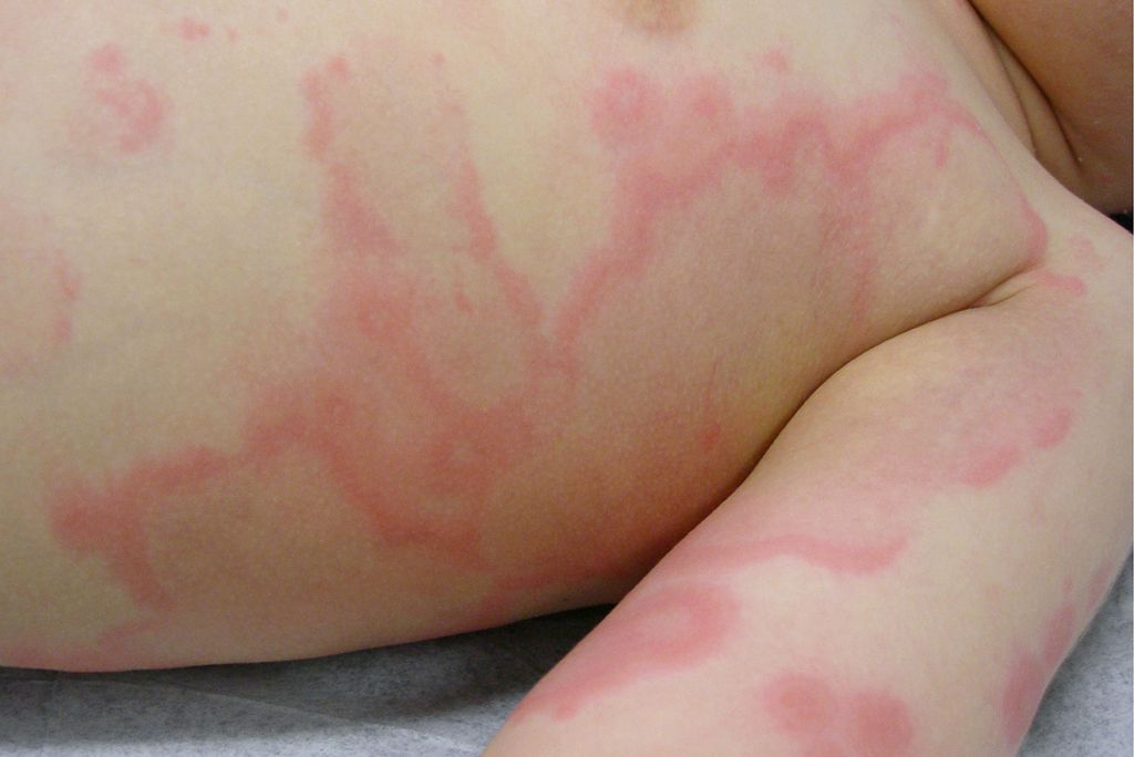 Common Child Skin Problems - Hives