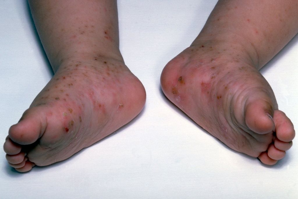 Childs Skin Rash - Scabies