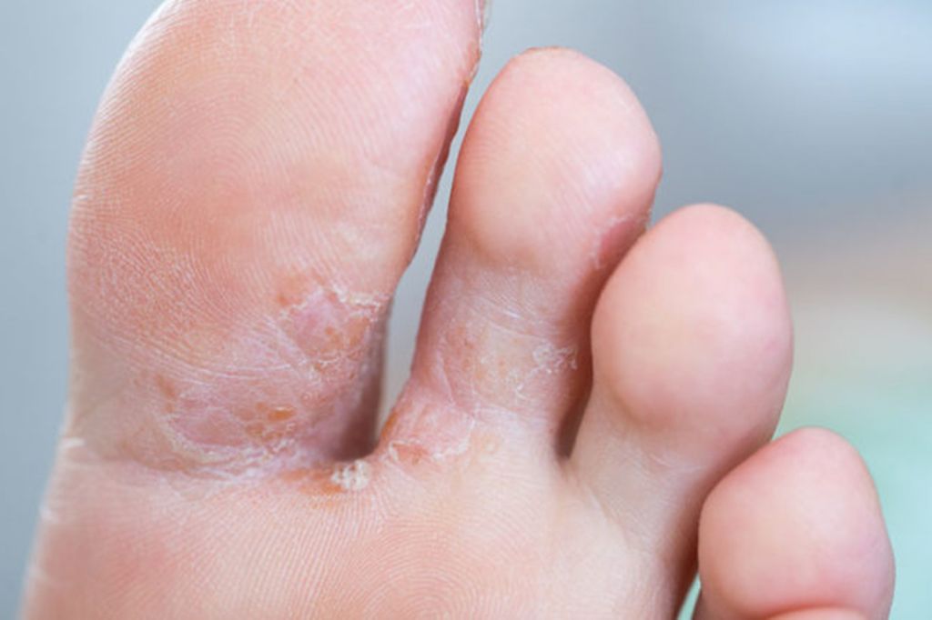 Childs Skin Rash - Athlete's foot