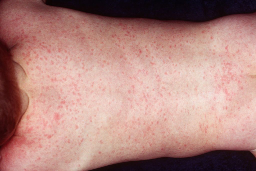 Common Child Skin Problems - Roseola - Sixth Disease