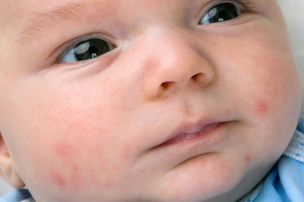 Childs Skin Rash - Baby Acne