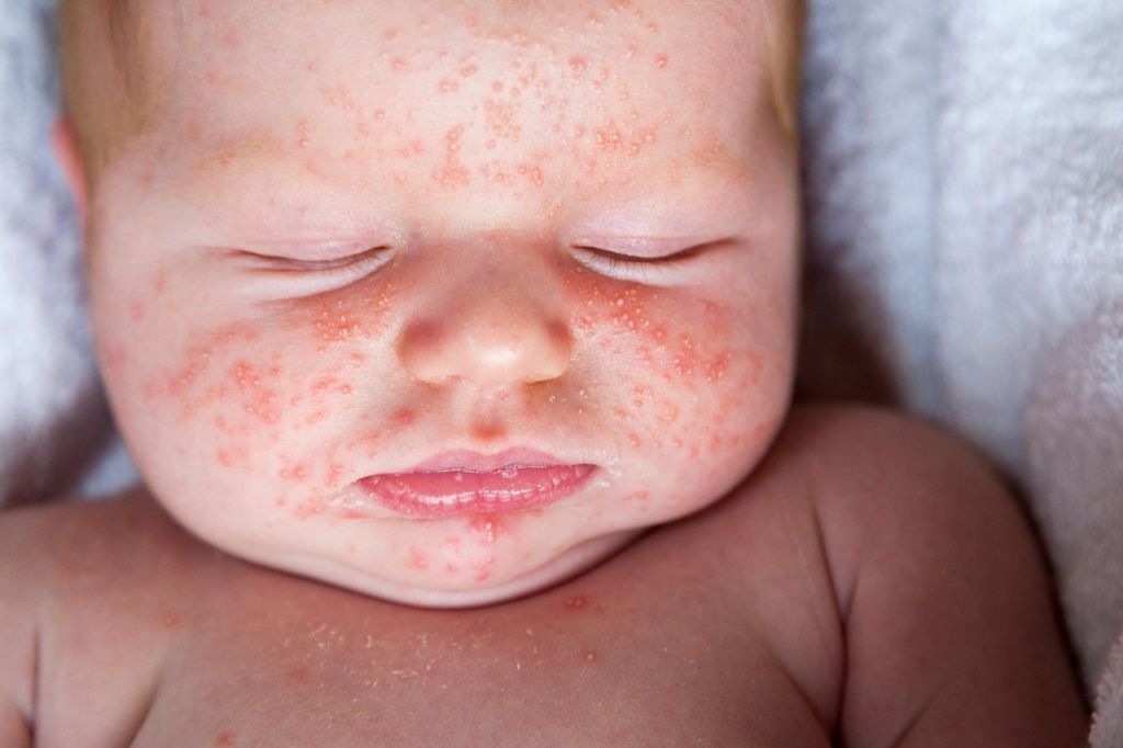 Childs Skin Rash - ERYTHEMA TOXICUM