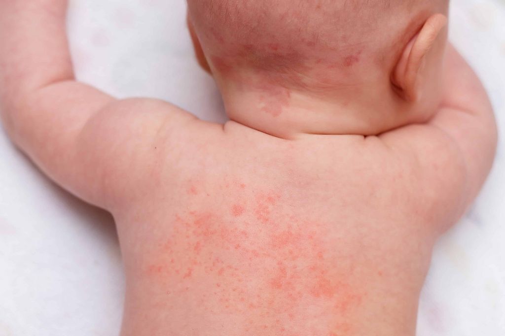 Childs Skin Rash - Prickly Heat