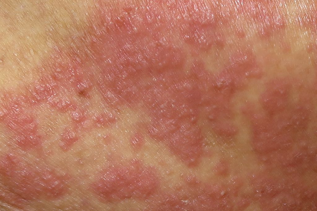Childs Skin Rash - Candidal rash