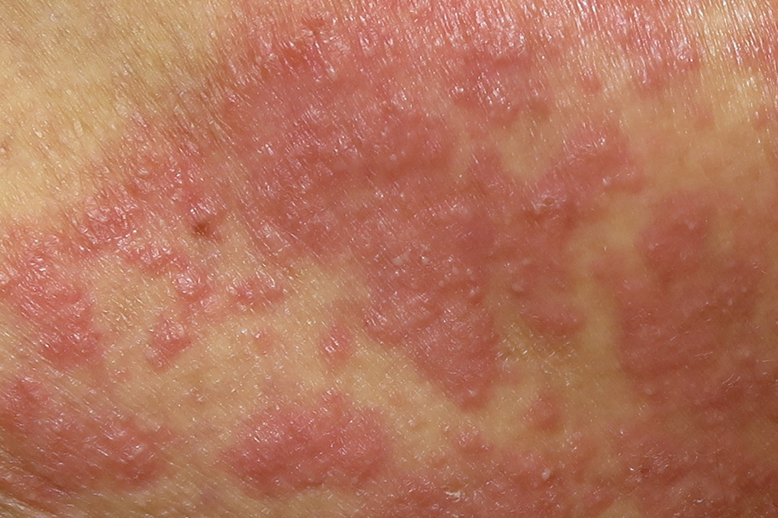 20 Causes for Your Childs Skin Rash Diagnosis & Treatment Pure Medical