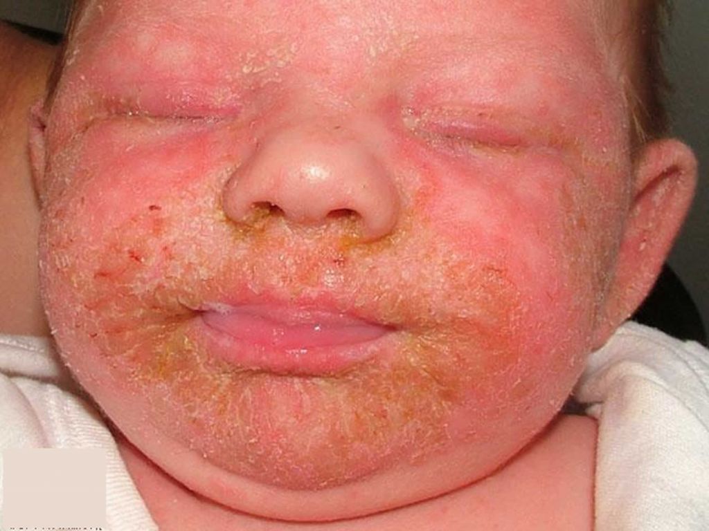 Childs Skin Rash - Infantile Seborrheic Dermatitis