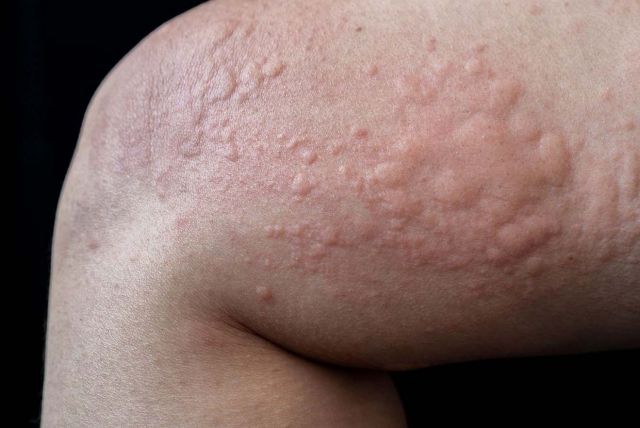 Childhood Skin Rashes