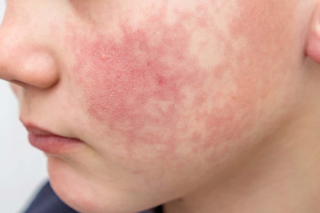 Fifth Disease Slapped Cheek Syndrome Symptoms and Causes Pure Medical