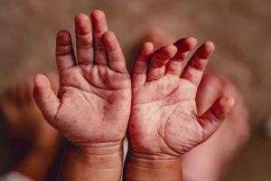 Hand Foot and Mouth Disease