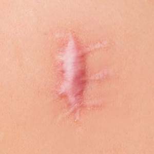 Pure Medical Spa - Keloid Scar Removal 