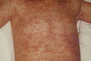Measles