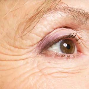 Pure Medical Spa - Wrinkles 