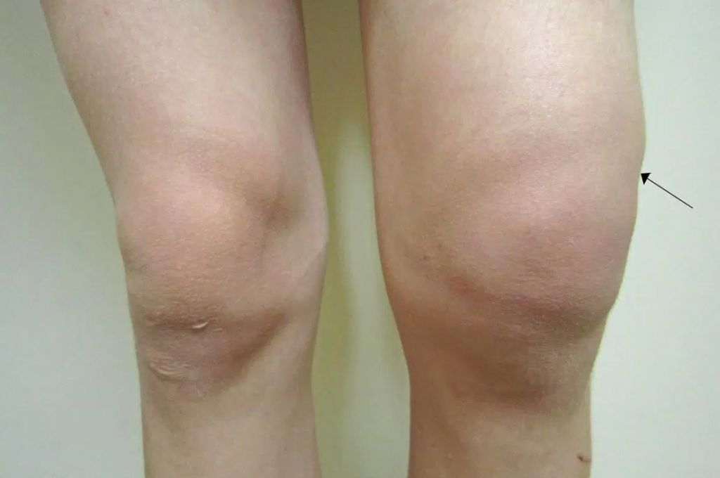 Lyme Disease Symptoms - Swollen Knee