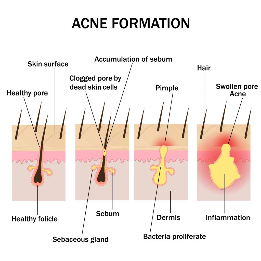 Pure Medical - Acne formation diagram