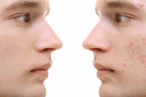 Infrared Sauna For Acne
