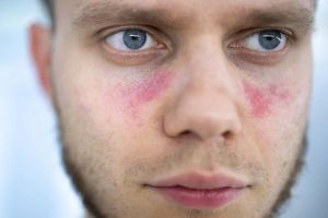 Pure Medical - Lupus Treatments