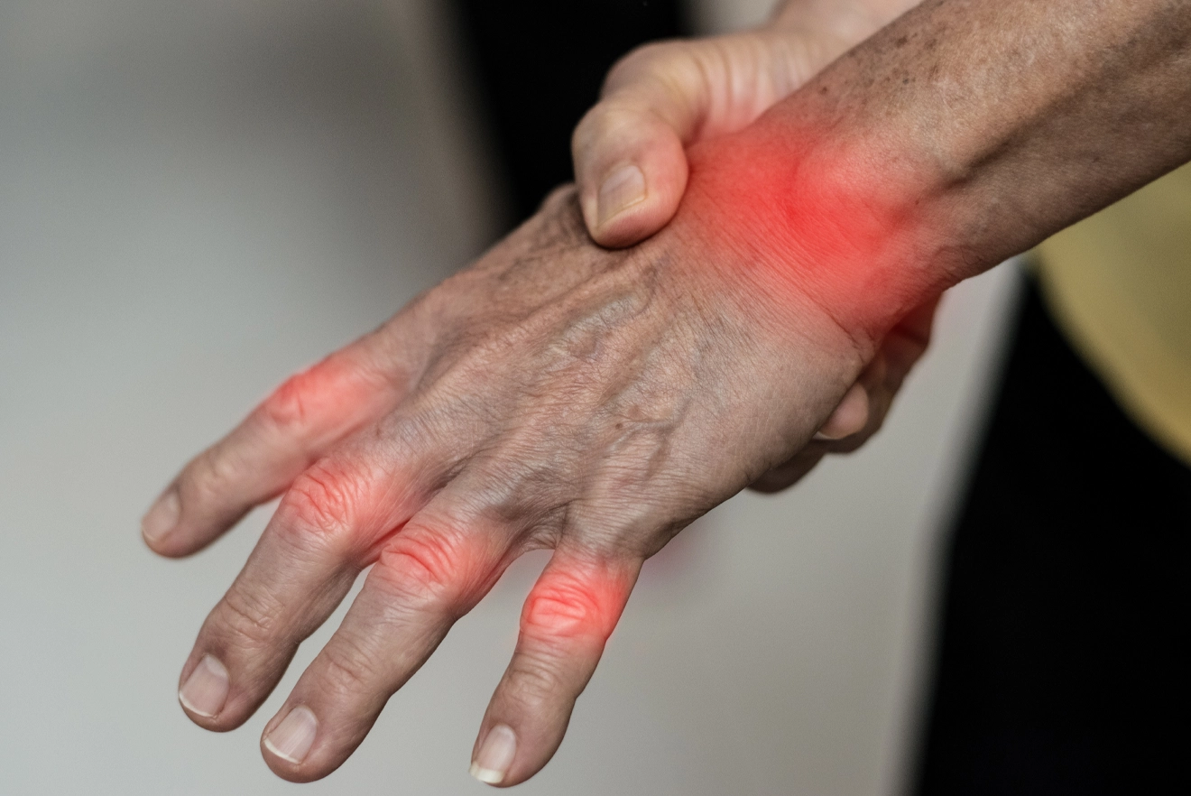 Rheumatoid Arthritis Treatment UK 2023 Pure Medical