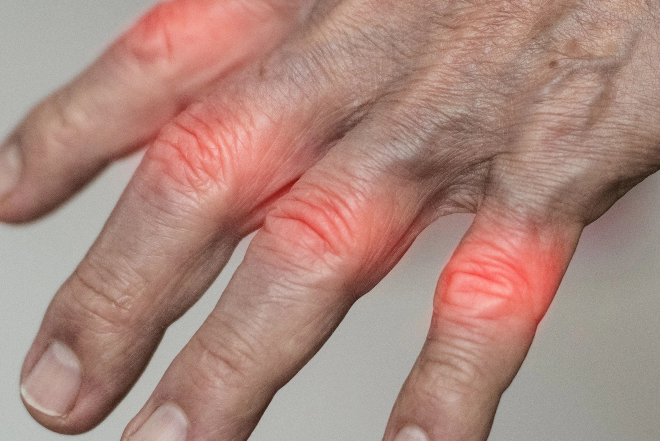 What causes Gout? How does it affect your body? 2023 Pure Medical