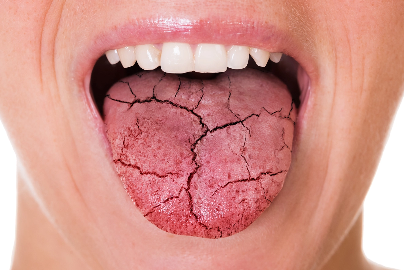 Dry Mouth Symptoms, Causes, Diagnosis & Treatment Pure Medical
