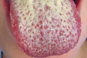 Oral Thrush