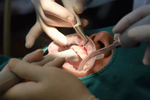 Tooth Abscess