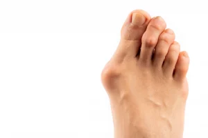 Hallux Rigidus (Stiff Big Toe)